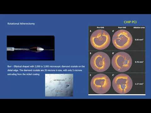 Managing calcified lesions in the cath lab  - the role of rotablator therapy and IVL