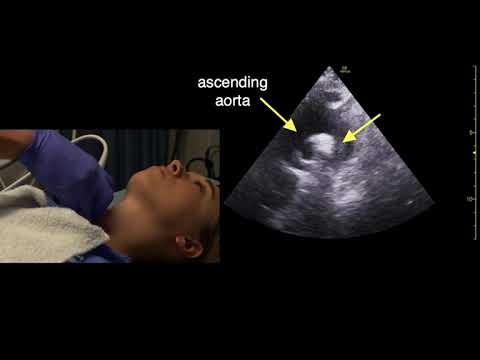 Suprasternale Echokardiographie-Scan-Technik