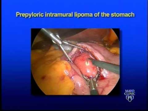 Prepyloric Intramural Lipoma of the Stomach - Laparoscopic Excision
