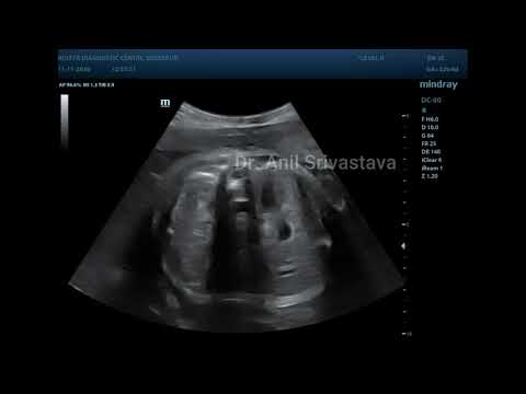 Unilateral HYDRONEPROSIS in fetus in 2nd trimester