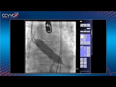Valve-in-Valve SAPIEN-3 TAVR - 2018 CCC Live Case 4