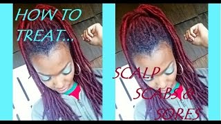 How To Treat Your Scalp Sores and Scabs (for all hair types)