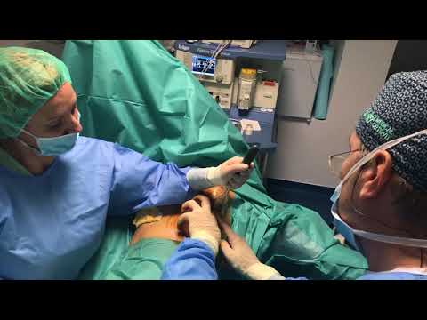 Chirurgie de mărire a penisului germaniu