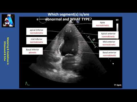 Wall Motion Abnormality Part II: cases & practice