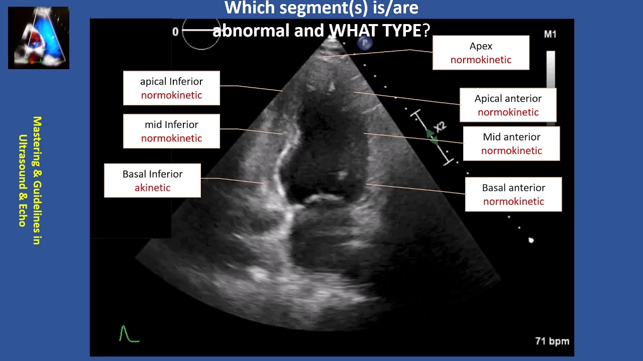 Wall Motion Abnormality Part II: cases & practice