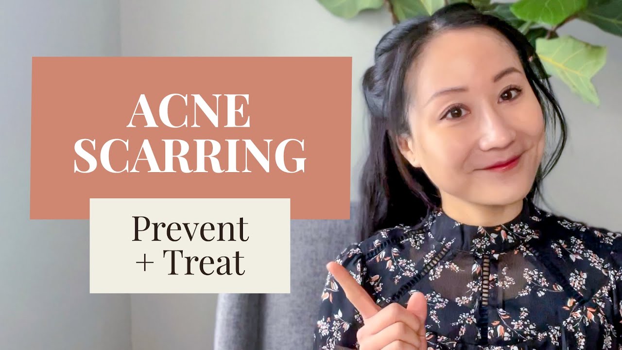 ACNE SCARS  + HYPERPIGMENTATION - How to Treat and Prevent Them according to a Dermatologist