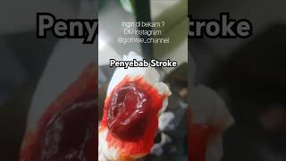 Download lagu ini nih penyebab stroke didalam tubuh #pengobatan #pengobatanalternatif #bekam #hijamah #terapi mp3 Download lagu ini nih penyebab stroke didalam tubuh #pengobatan #pengobatanalternatif #bekam #hijamah #terapi mp3