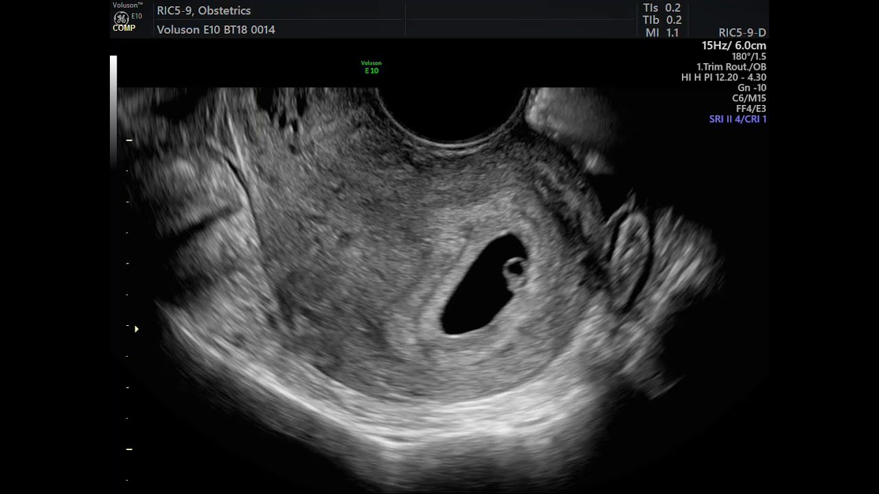 ULTRASSON ENDOVAGINAL PARA AVALIAÇÃO DE GESTAÇÃO INICIAL