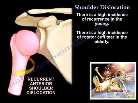 Shoulder Dislocation Associated Lesions - Everything You Need To Know - Dr. Nabil Ebraheim