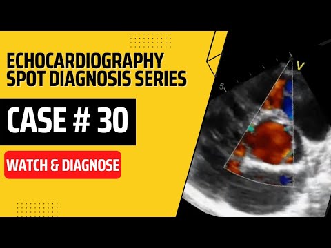 Case 30: Echocardiography Spot Diagnosis Case Series  #echocardiography #echo #cardiology #case