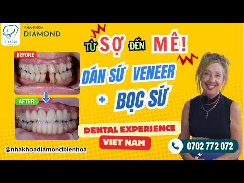 Ms. Tatiana (Australia) shares her experience with porcelain veneers and crowns at Diamond Dental Clinic Bien Hoa