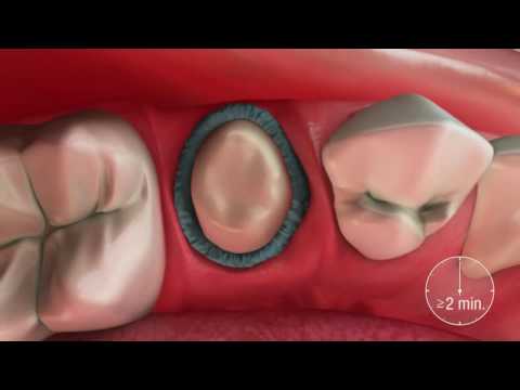 Gingival Retraction Paste