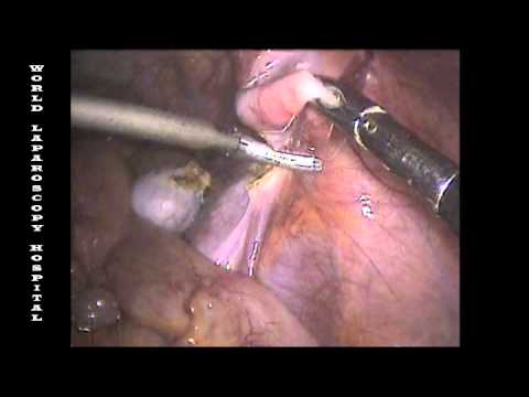 Frequently asked questions about orchiectomy