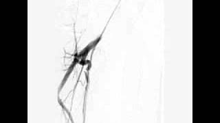Abnormal Remnant right radial & loop straightened with BMW & JR.MPG