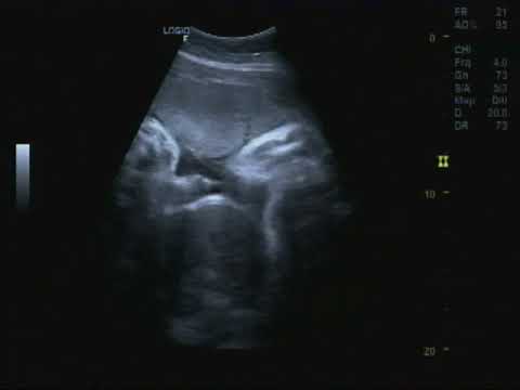 SieuAm HUỲNH THỊ TUYẾT HỒNG 1981 Tân Quới, Thai khoảng 34 tuần-Pk Bs Trần Thị Út Hai