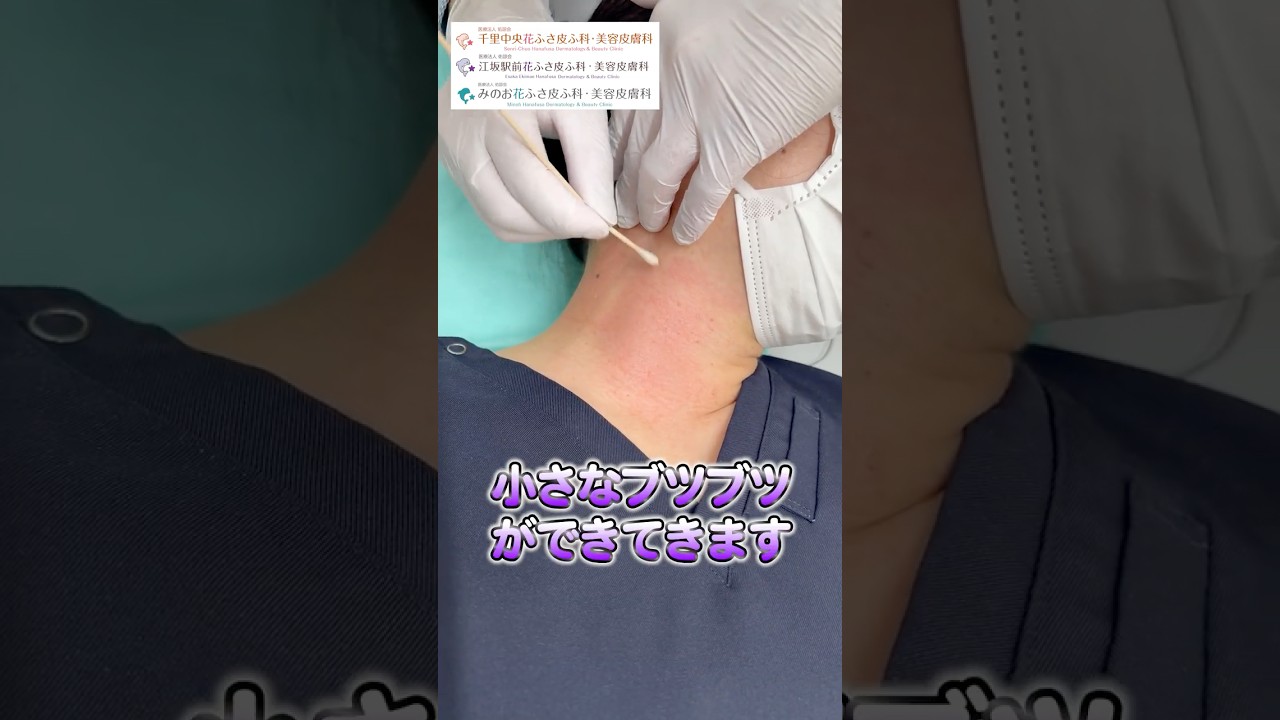 首のイボ、実は老化現象かも？200個以上できることもあるアクロコルドンを炭酸ガスレーザーで一つひとつ丁寧に除去！