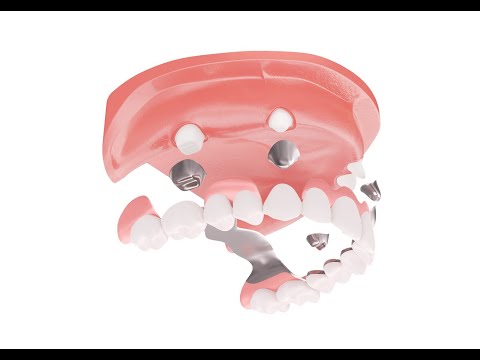 Behandlungsablauf: Teleskopprothese Zahnersatzsparen.de