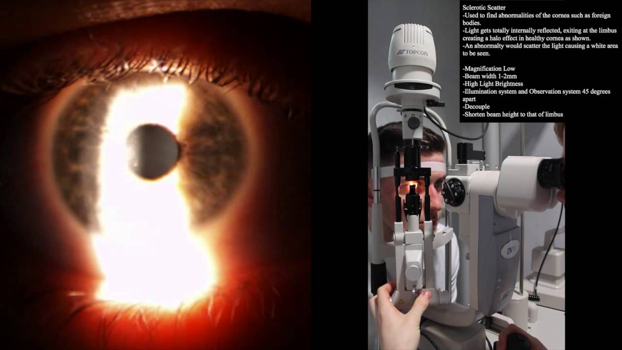 Slit Lamp: Sclerotic scatter