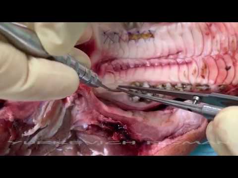 Tuberosity gum CTG harvesting / Забор десневого трансплантата с бугра верхней челюсти