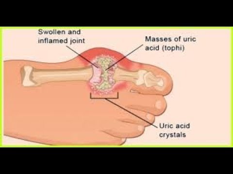 Gout Treatment Success
