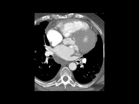 Rare subtype of caseous necrosis of the mitral annulus/valve with atypical extension.