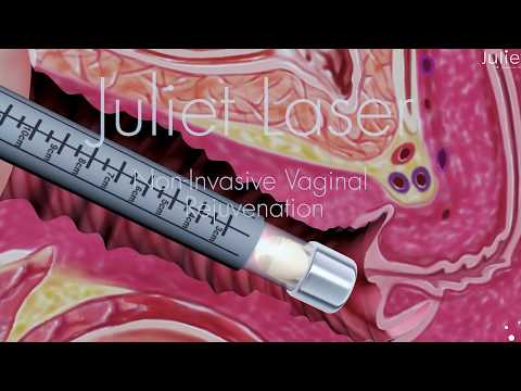 Juliet Laser - Non-invasive Vaginal Rejuvenation