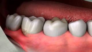 preview picture of video 'The How and Why of Wisdom Tooth Removal in Columbia, Missouri'