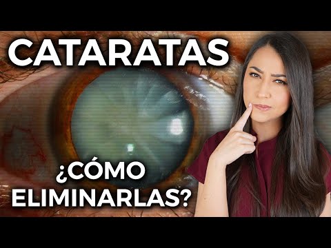 This is how you get rid of CATARACTS 👁 l Everything you need to know 👩🏻‍⚕️ @DraPauZuniga