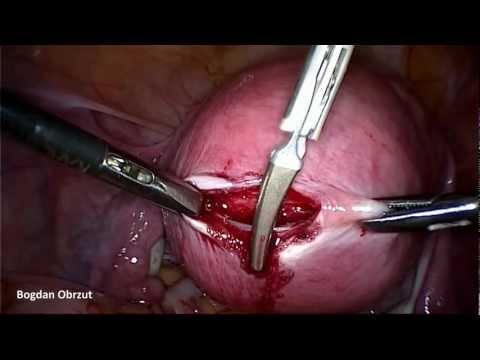 Enucleation of the uterine fibroid