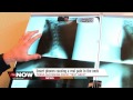 Kids & Teens Suffering from Text/Tech Neck