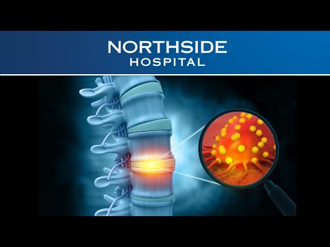 The Current Landscape of Bone Cancer Treatments