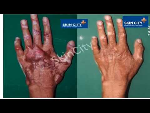 Scar Treatment Laser - UltraPulse con SCAAR FX l Skincity l Dr Dhepe
