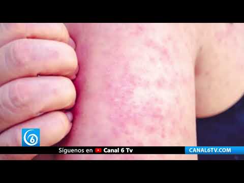 Video: Advierten por brotes de sarampión en diferentes partes del mundo