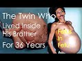 The Twin Who Lived Inside His Brother for 36 Years | Miracle In Medical Science | Fetus in Fetu