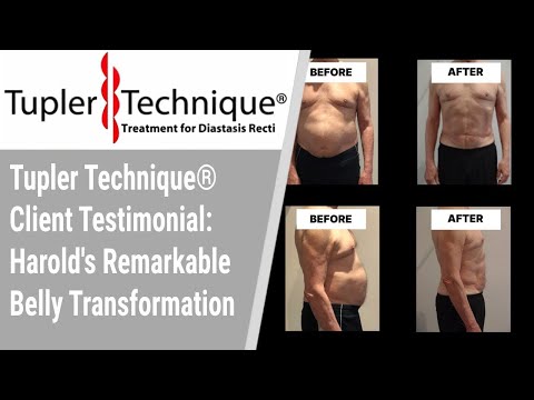 Tupler Technique® Client Testimonial: Harold's Amazing Belly Transformation