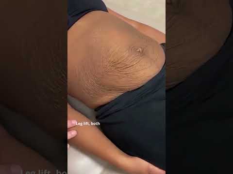 This is what a Diastasis Recti looks like! #shorts #tummytuckprocedure #diastasisrectirepair