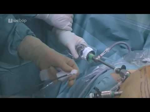 Narbenhernienreparation, Dynamesh® , IPOM