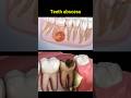 Tooth Abscess Problem Dentist Dentisty Teeth Dental