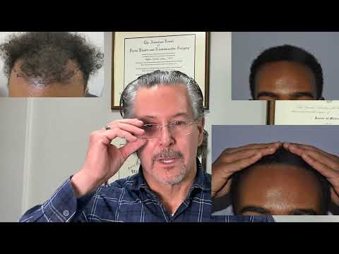 Younger patient at 13 months out from excellent hair transplant by Dr. Lindsey in McLean | DC | MD thumbnail