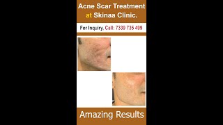 Acne Scar Treatment at Skinaa Clinic | viral #shorts