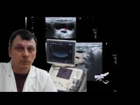 Pediatric Female pelvic ultrasound - Small pelvis lesion, presumably hydrocolpos