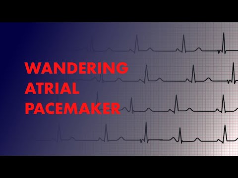 Wandering Atrial Pacemaker -  EKG (ECG) Interpretation