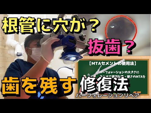 生命歯学科 歯の根っこに穴が空いている・・・。抜歯をせずに歯を残す！マイクロスコープを用いたパーフォレーションリペアについて解説します！