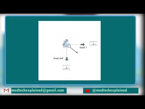 ECG FAST TRACK (part 15): Normal lead and axis