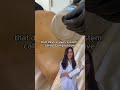 Before and after Endospheres therapy