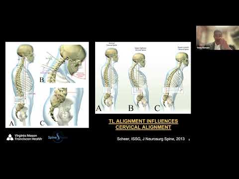 Cervical Deformity – Surgical Decision Making Principles presented by Venu Nemani, MD