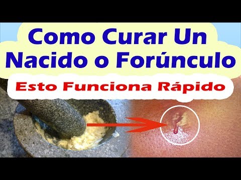 Como curar un forunculo- remedios caseros