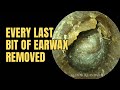 Every Last Bit Of Earwax Removed