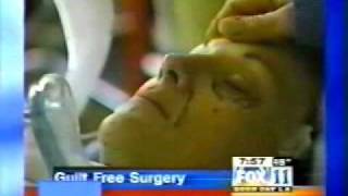 Beverly Hills Plastic Surgery News | Guilt-Free Facelift
