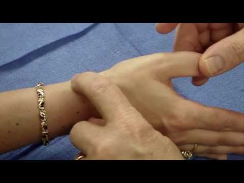 DeQuervain's Tendonitis